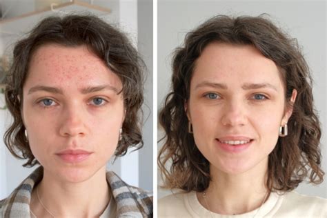 How Often Should You Do Microneedling? - Yastrid Medical Aesthetic Supplier