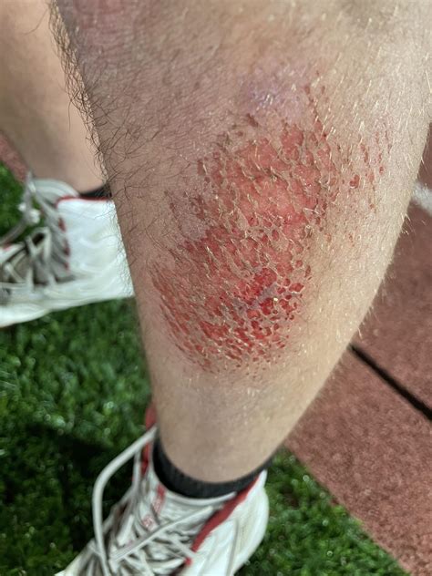 The turf burn I got tonight looks like camo : r/mildlyinteresting