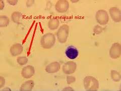 Differential Diagnosis of Anisocytosis - Medical Zone