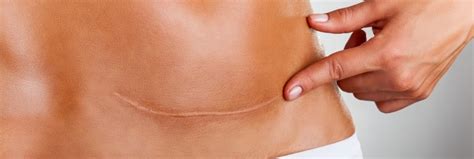 Hypertrophic Scars Treatment Los Angeles | Treat Hypertrophic Scars