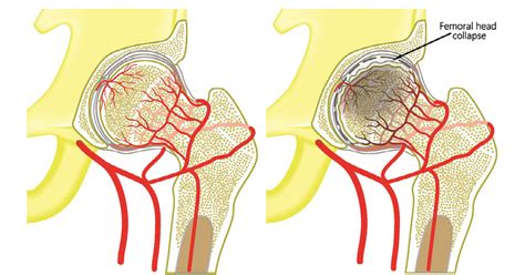 Avascular Necrosis: Symptoms, Causes, Diagnosis, Treatment & Prevention
