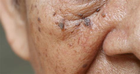 Skin Tags On Face
