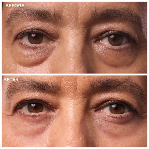 Bags Under Eyes And Allergies at Erick Crowe blog
