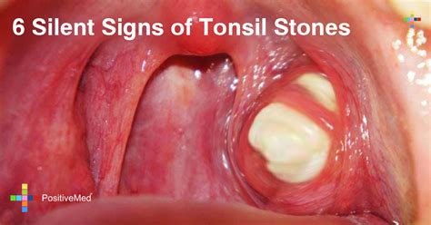 symptoms  tonsil cancer nhs throat  mouth cancer tavsk