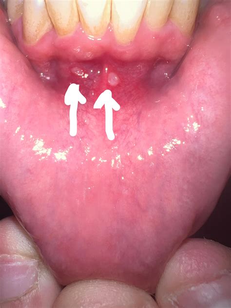 canker sores? : r/CankerSores