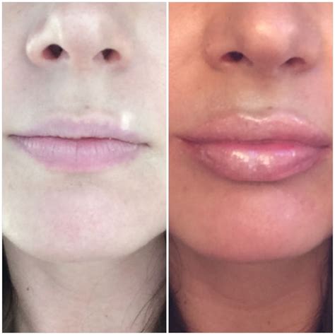 Lip Filler Before And After