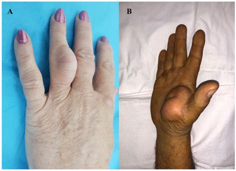 Lipoma