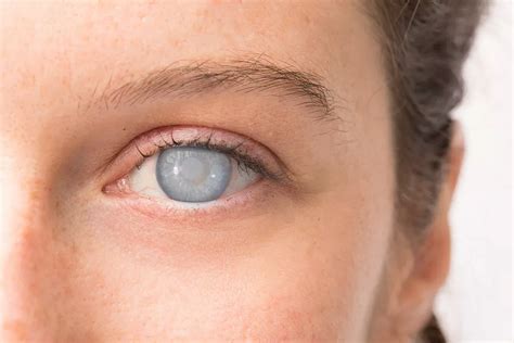 What Age Do Cataracts Start Developing? NeoVision Eye Center