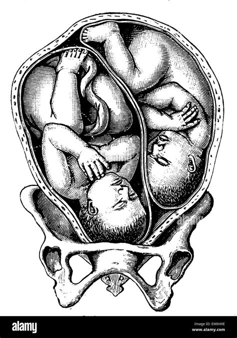 Twins in cephalic presentation Stock Photo - Alamy