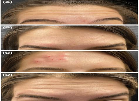 Dermatologic Surgery