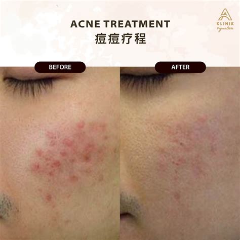 acne treatment  kl penang  klinik signature