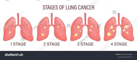 Stages Lung Cancer Lung Disease Medical Stock Vector (Royalty Free ...