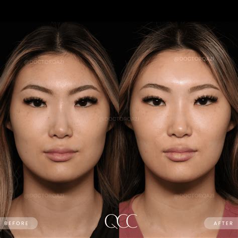 Masseter Botox using Dysport