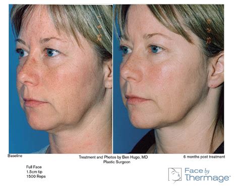 Thermage Skin Tightening - Laser Spa Group