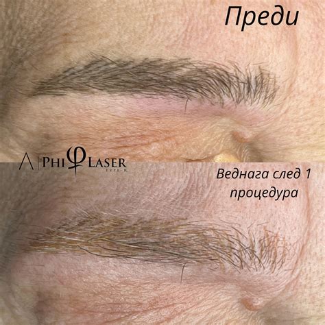 Лазерно премахване на перманентен грим на вежди с Philaser (разграбена ...