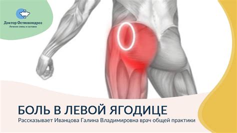 Болит левая ягодица. Возможные причины и что делать. - YouTube