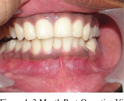 figure   pyogenic granuloma  case report semantic scholar
