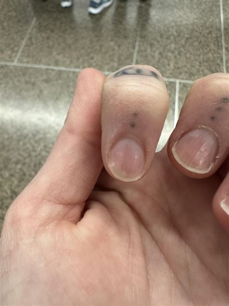 Nail Fungus: real advice from real people for healthy toenails and