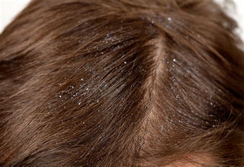itchy scalp hair loss 4