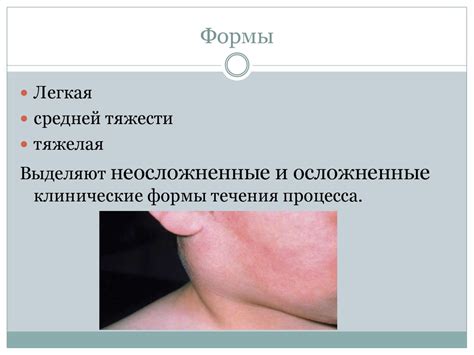 Эпидемический паротит (свинка, заушница) - презентация онлайн