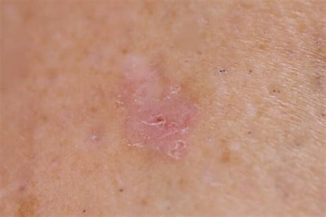 Cafe au Lait - South East Skin Clinic