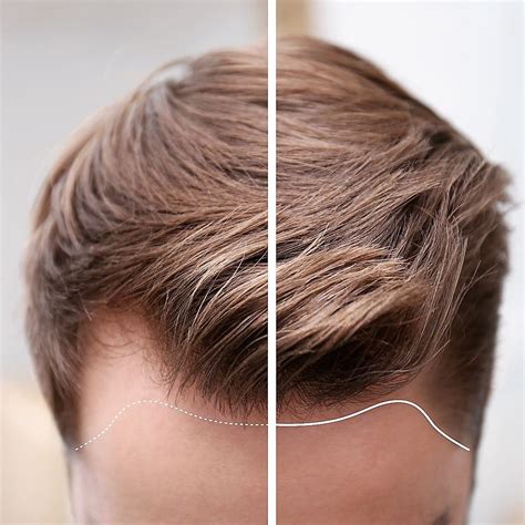 Uneven Hairline: Why It Happens & Should You Worry?