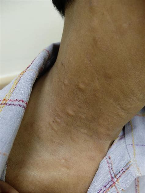 Figure 1 from Scleroderma with Nodular Scleroderma | Semantic Scholar
