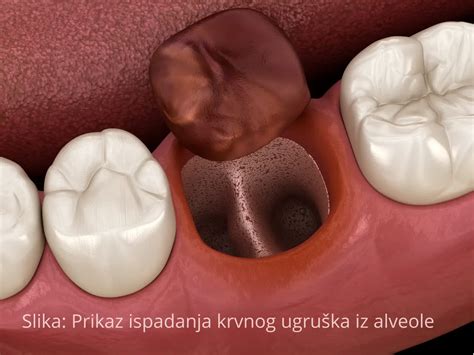 Bol nakon vađenja zuba | Potraži pomoć stomatologa