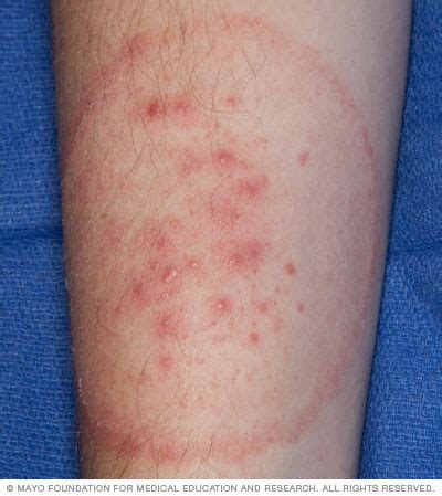 Ringworm Rash Causes