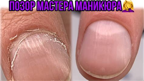 Что такое птеригий на ногтях фото