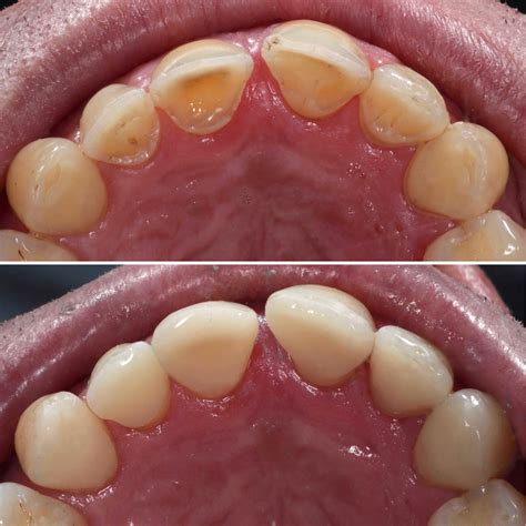 Tooth wear management - Chalfont Dentist