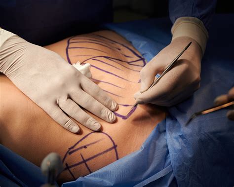 If BBL Safety Measures Exist, Why Are Mortality Rates So High? - Public