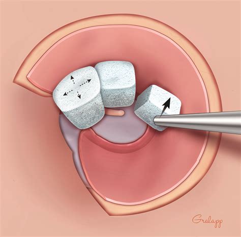 Lateral Graft Tympanoplasty – Oto Surgery Atlas