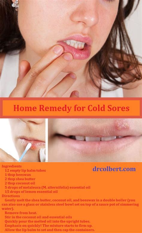 Cold Sore remedy. | Cold home remedies, Natural home remedies, Cold ...
