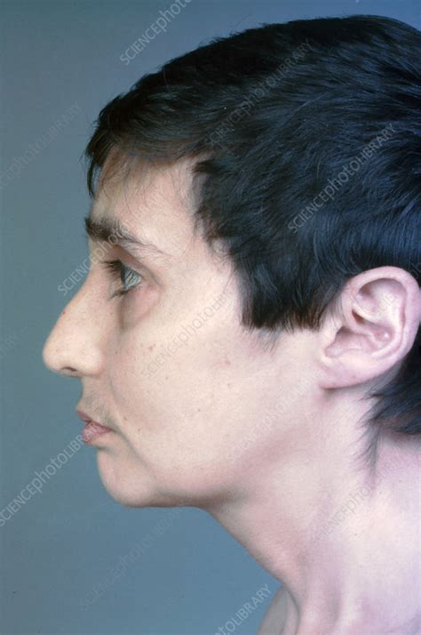 Panhypopituitarism - Stock Image - C036/5779 - Science Photo Library