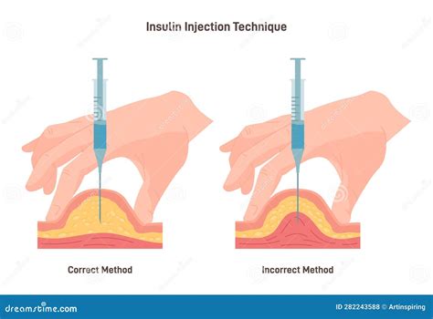 insulin injection technique correct  incorrect  cross section