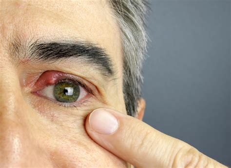 Stye (Sty): What Is It, Causes, Treatment & Prevention - Eat Guardian