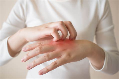 Coceira Nas Mãos E Pés À Noite - Por que dengue coça tanto? Médico explica coceira nas mãos e pés ...