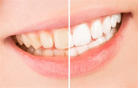 Coffee Stains Teeth? What You Should Know Before Your Next Cup ...