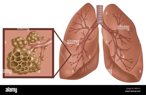 Alveoli of lungs hi-res stock photography and images - Alamy