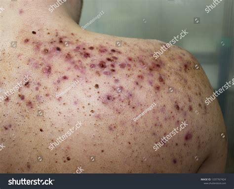 410 Severe Acne Images, Stock Photos & Vectors | Shutterstock