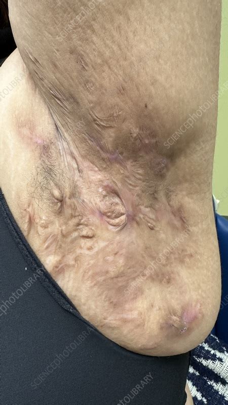 how to get rid of hidradenitis suppurativa scars
