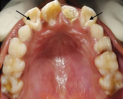 Academy of Dental Knowledge: Dens in Dente