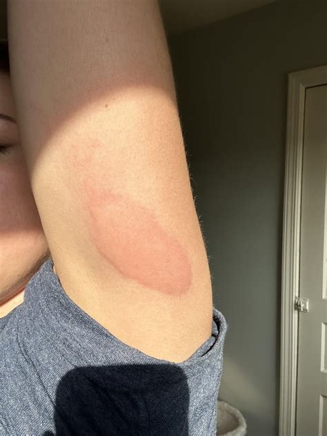 Allergy shot reaction : r/Allergy