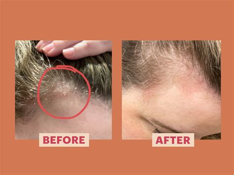 Guide To Scalp Psoriasis Know Their Symptoms Treatmen - vrogue.co