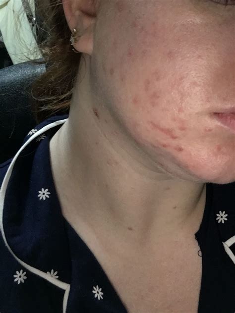 The Wonderful Wild: Roaccutane (isotretinoin)- The first sign of side ...