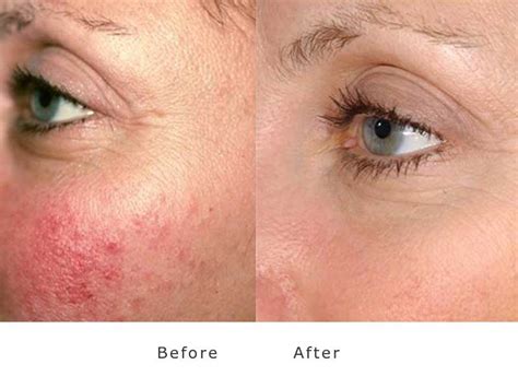 Acne Rosacea Before After