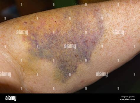 large bruise   caucasian womans forearm close   elbow showing