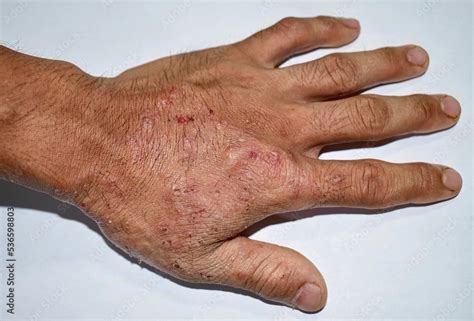 Itchy skin lesions in hand of Asian man. It may be caused by scabies ...