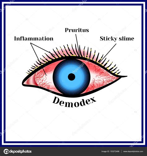 Demodex. Parasitic eye disease. — Stock Vector © mrs.bazilio.gmail.com ...